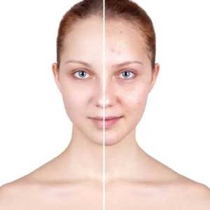 Acne Treatment in Janakpuri