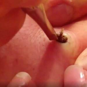 Blackhead Removal in Civil Lines