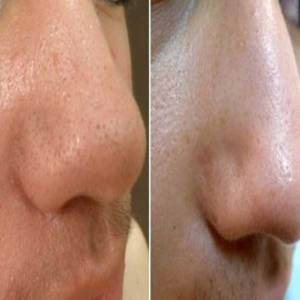 Blackhead Treatment in Defence Colony