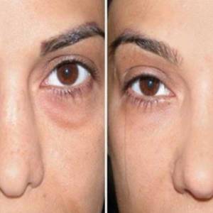 Dark Circles Treatment in Laxmi Nagar