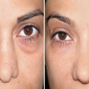 Dark Circles Treatment in Vasant Kunj