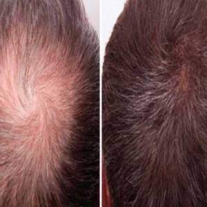 Derma Rollers for Hair Growth and Stop Hair Fall in Model Town