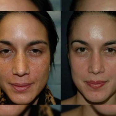 Discoloration Treatment in Model Town