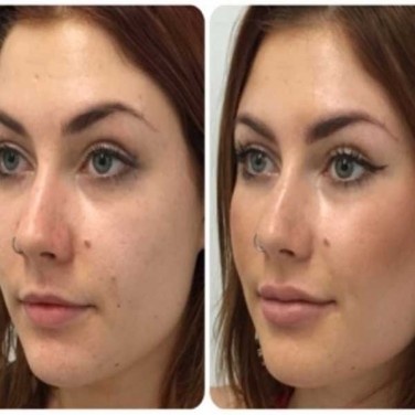 Fillers for Lip Enhancement or Cheeks Augmentation in Model Town