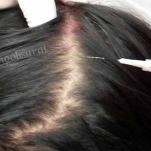 Hair Growth Treatment Through RF in Defence Colony