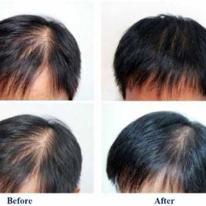 Hair Growth Treatment in Saket