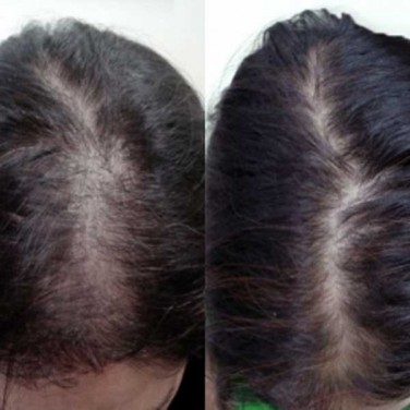 Mesotherapy for Hair Growth and Stop Hair Fall in Shalimar Bagh