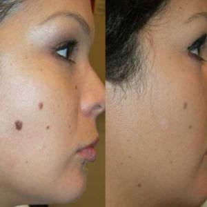 Mole Removal in Uttar Pradesh