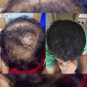 PRP Treatments for Hair Growth and Stop Hair Fall in Delhi