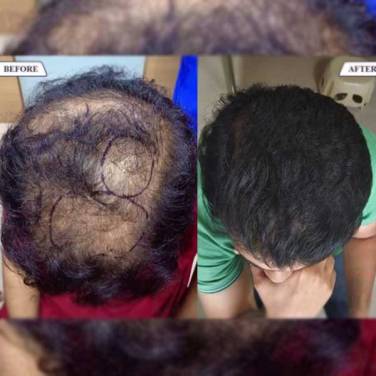 PRP Treatments for Hair Growth and Stop Hair Fall in Delhi