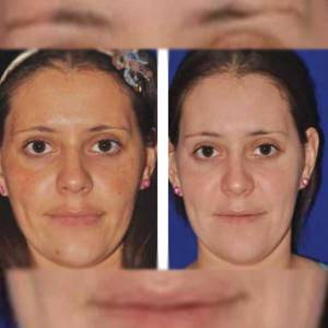 PRP for Facial Glow Skin Tightening Removal of Fine Lines and Wrinkles in Mehrauli