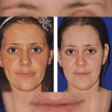 PRP for Facial Glow Skin Tightening Removal of Fine Lines and Wrinkles in Rohini
