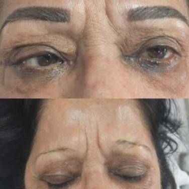 Permanent Eyebrow Enhancement in Delhi