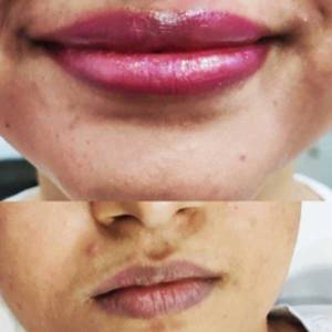 Permanent Lip Coloring in Daryaganj