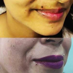 Permanent Mole Creation in Ashok Nagar