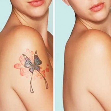 Permanent Tattoo Removal in Paschim Vihar