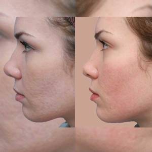 Post Acne Scars Removal in Daryaganj