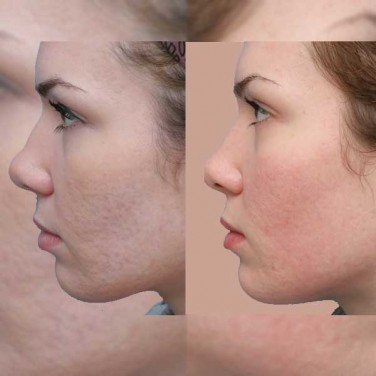 Post Acne Scars Removal in Shalimar Bagh