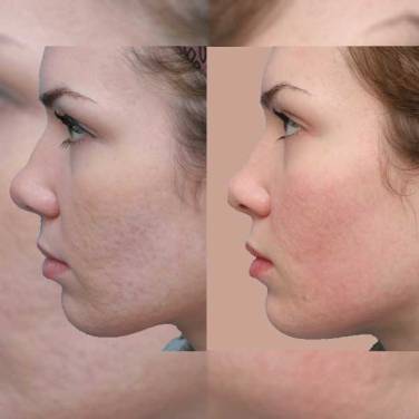 Post Acne Scars Removal in Vasant Kunj