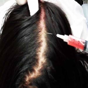 Stem Cell Therapy for Hair Growth and Stop Hair Fall in Naraina