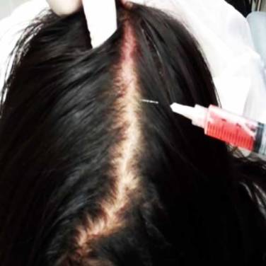 Stem Cell Therapy for Hair Growth and Stop Hair Fall in Paschim Vihar