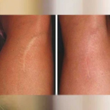 Stretch Marks Control Treatments in Model Town
