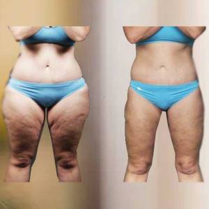 Thigh Tuck in Vasant Vihar