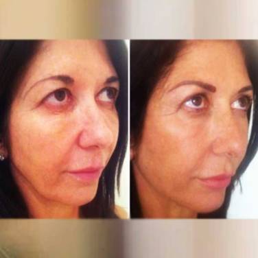 Threads for Skin Tightening in Lajpat Nagar