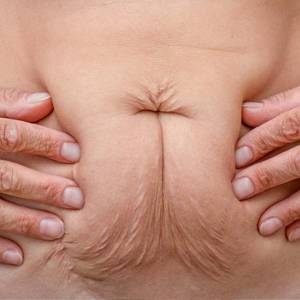 Abdominal Sagging in Kirti Nagar