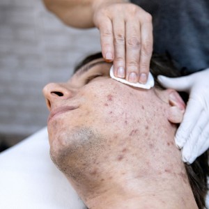 Acne Treatment in Janakpuri