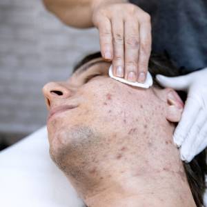 Acne Treatment in Preet Vihar