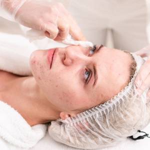 Acne Treatment in Sarita Vihar