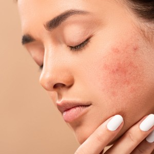 Acne Treatment in Shahdara