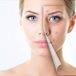 Acne Treatment in Defence Colony
