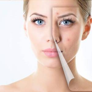 Acne Treatment in Pritam Vihar