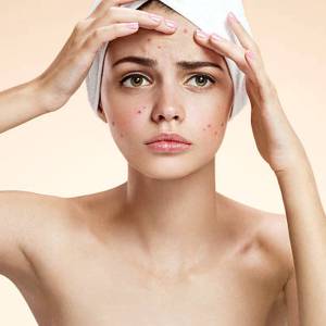 Anti Acne Treatment in Delhi