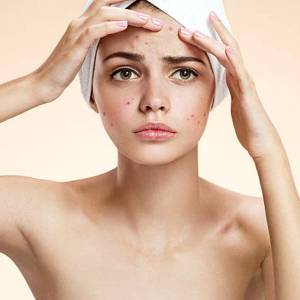 Anti Acne Treatment in Malviya Nagar