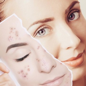 Anti Acne Treatment in Connaught Place