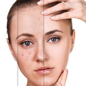 Anti Acne Treatment in Connaught Place