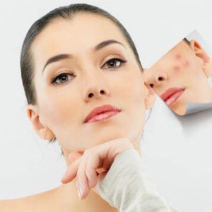 Anti Acne Treatment in Model Town