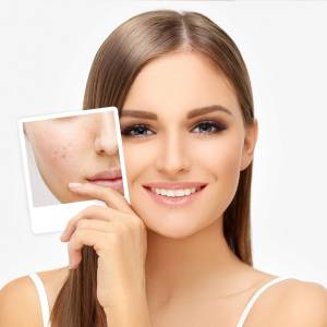 Anti Acne Treatment in Delhi