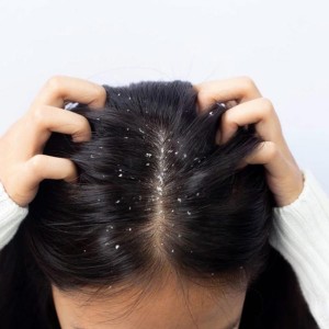 Anti Dandruff Treatment in Connaught Place