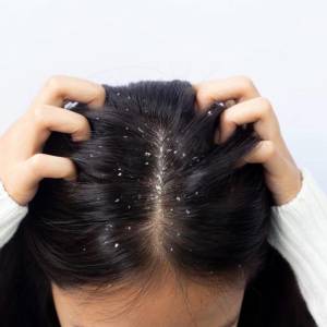 Anti Dandruff Treatment in Faridabad