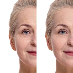 Anti Wrinkles Treatment in Preet Vihar