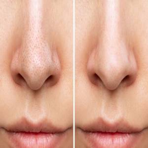 Blackhead Removal in Delhi