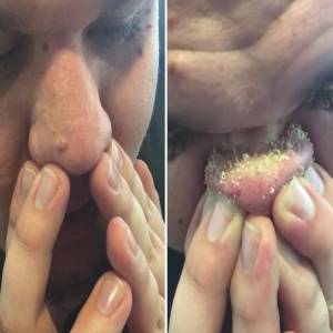 Blackhead Removal in Kalkaji