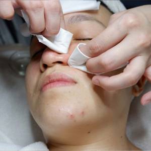 Blackhead Removal in Delhi