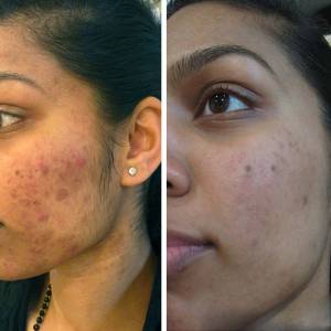 Blackhead Treatment in Nehru Place