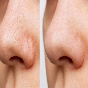 Blackhead Treatment in Connaught Place