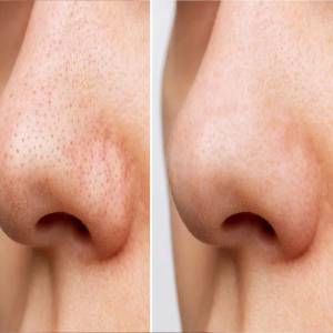 Blackhead Treatment in Agra